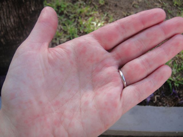 I Have A Rash And Blisters On The Palms Of My Hands And Feet 45